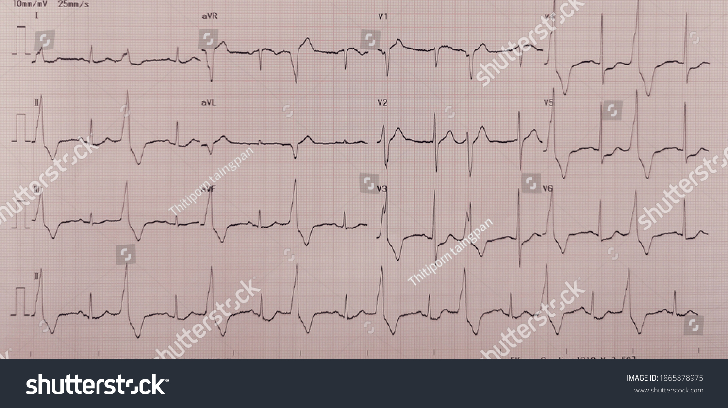 Photograph Shows Electrocardiogram Bigeminy Pvc St Stock Photo ...