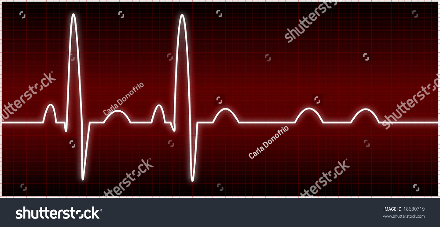 Abnormal Ekg Av Block Stock Illustration 18680719 | Shutterstock