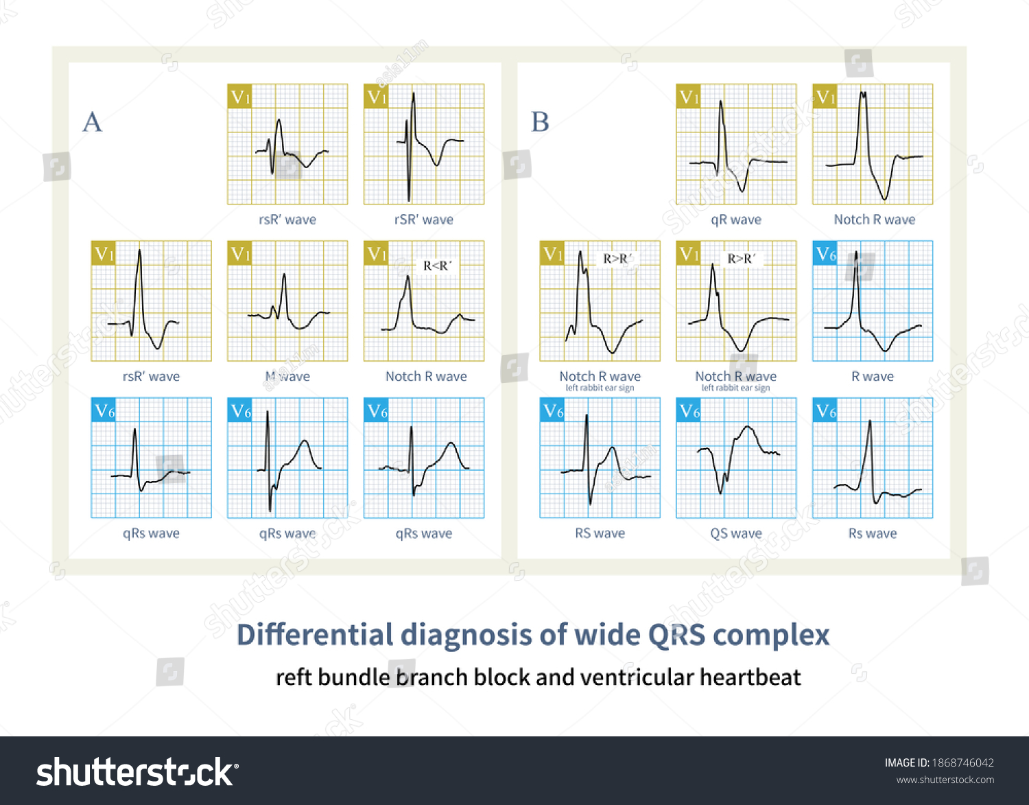 Wide Qrs Complex Complete Right Bundle Stock Illustration 1868746042 