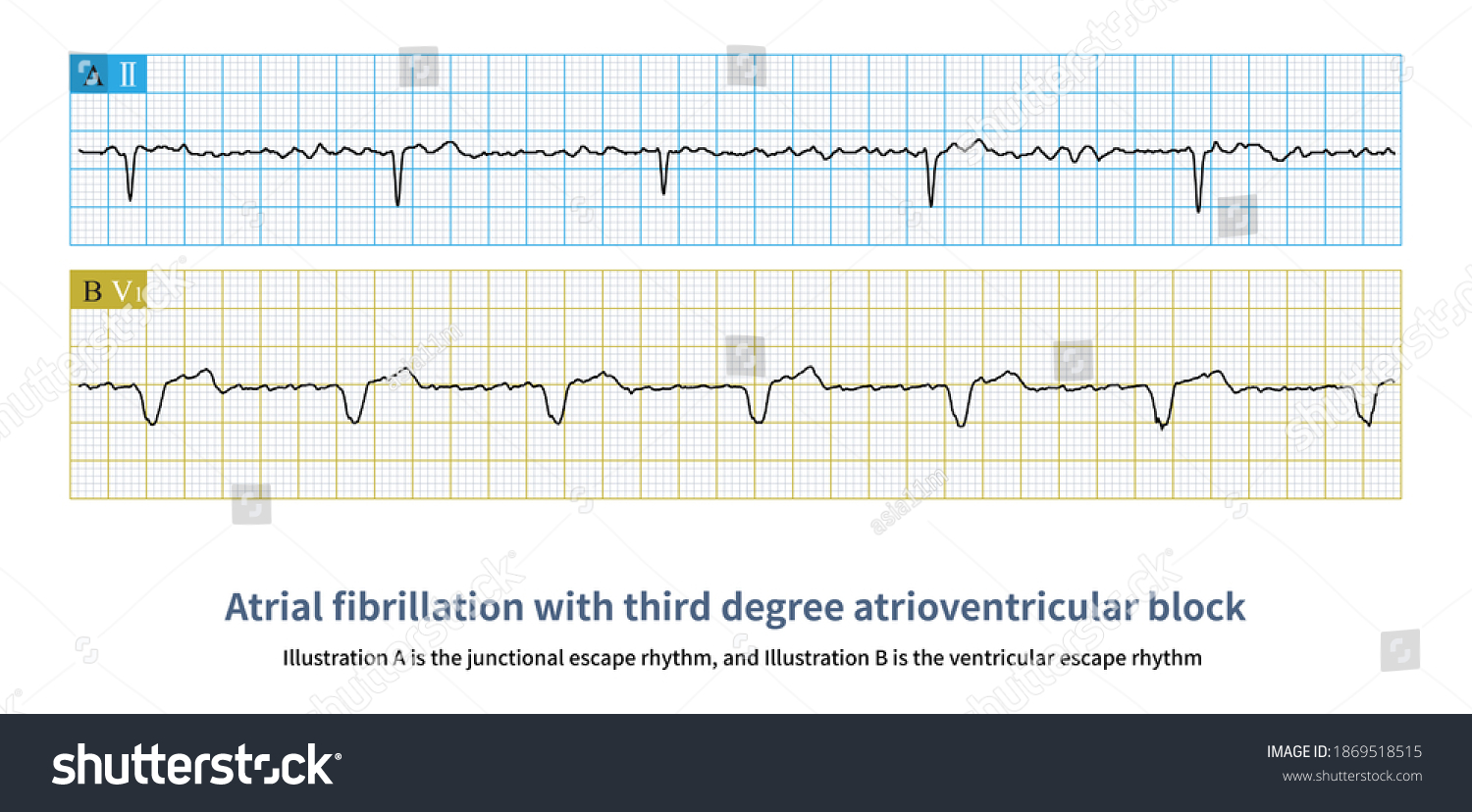 Atrial Fibrillation Ventricular Rate Found Be Stock Illustration ...