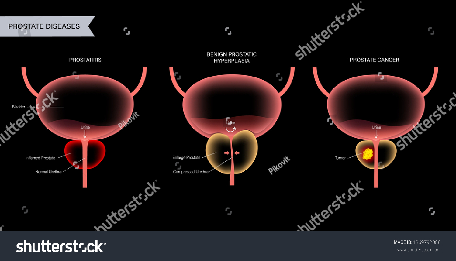 Prostate Disease Types Prostatitis Bph Cancer Stock Vector (Royalty ...