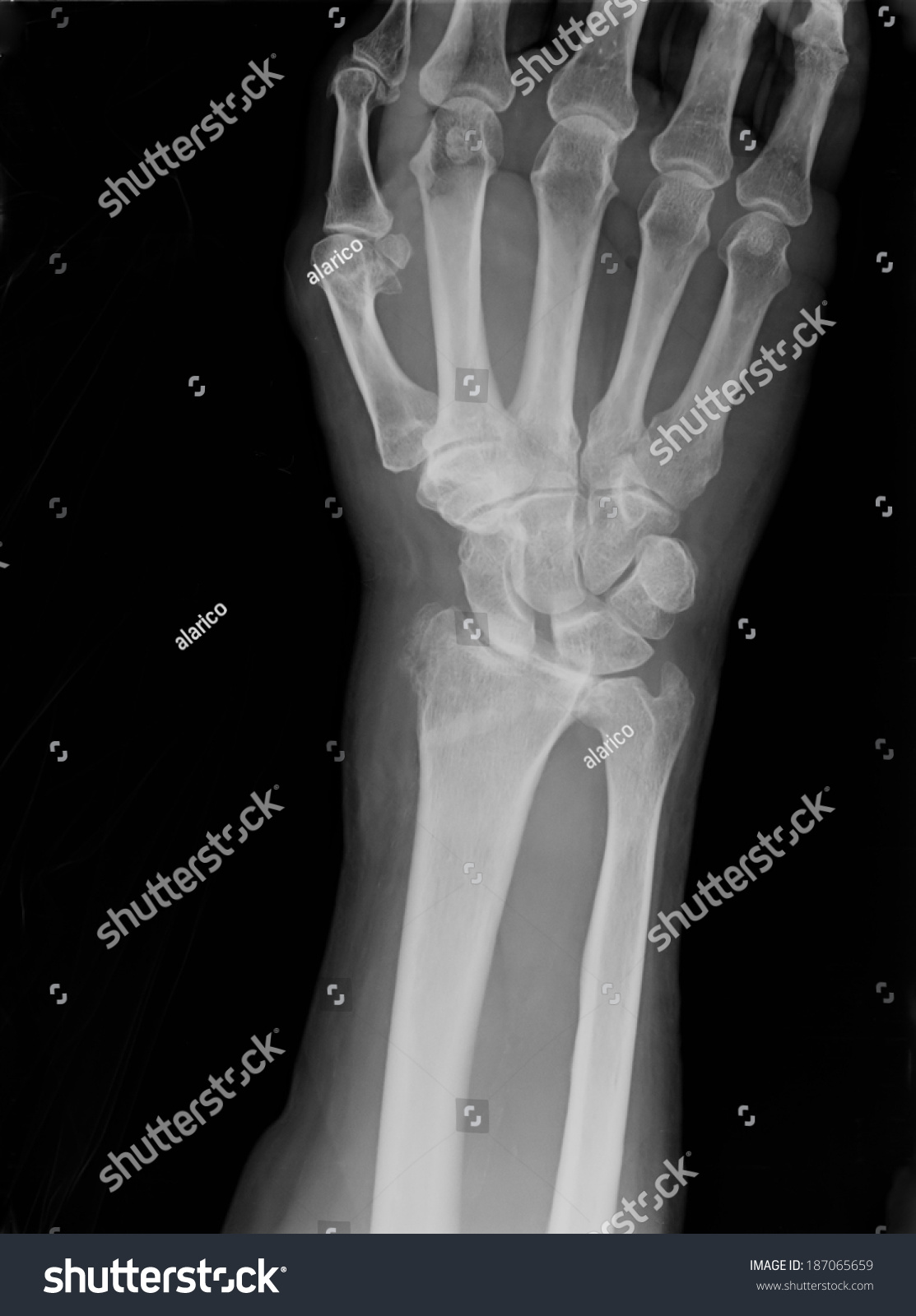 Xray Imaging Epiphysial Radial Fracture Wrist Stock Photo 187065659 ...