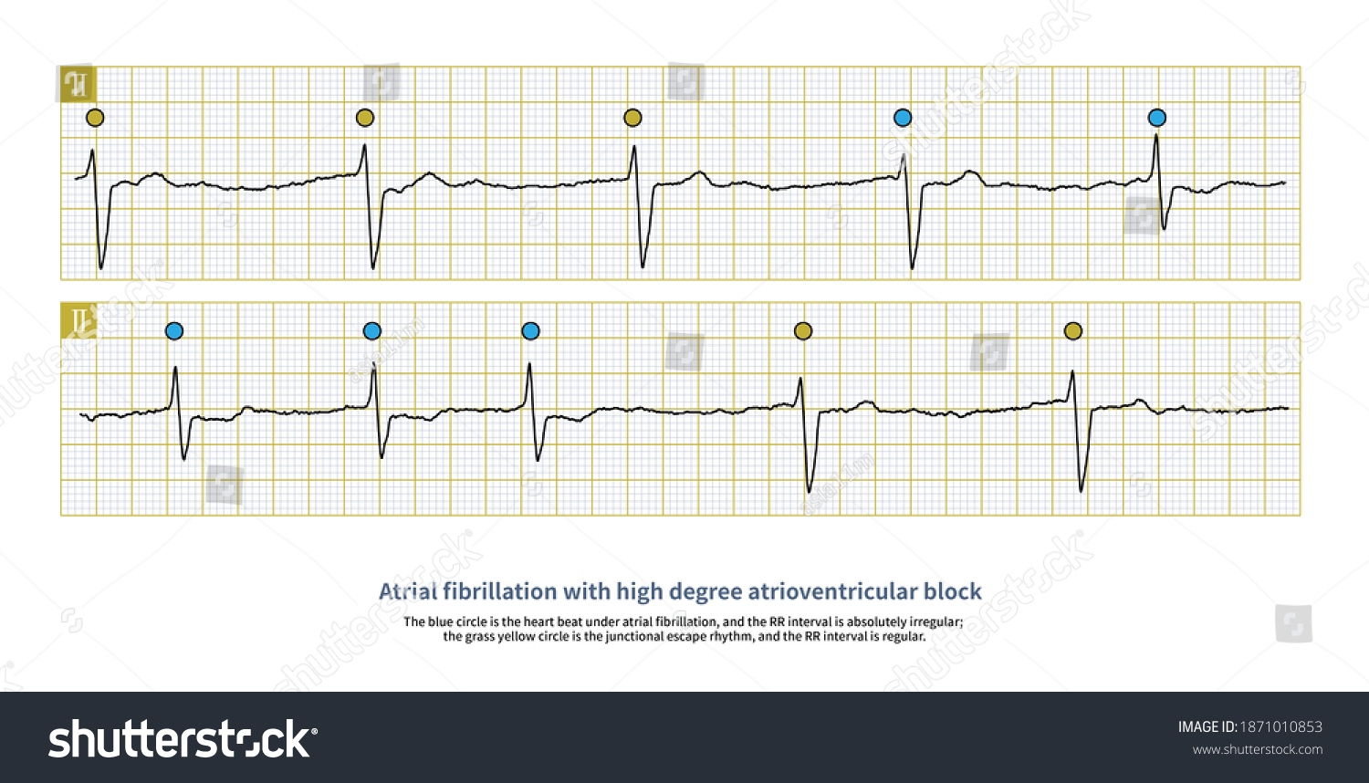 10 Rr Interval Images, Stock Photos & Vectors | Shutterstock