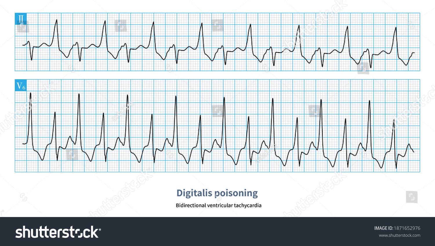 When Digitalis Poisoning Once Bidirectional Ventricular Stock ...