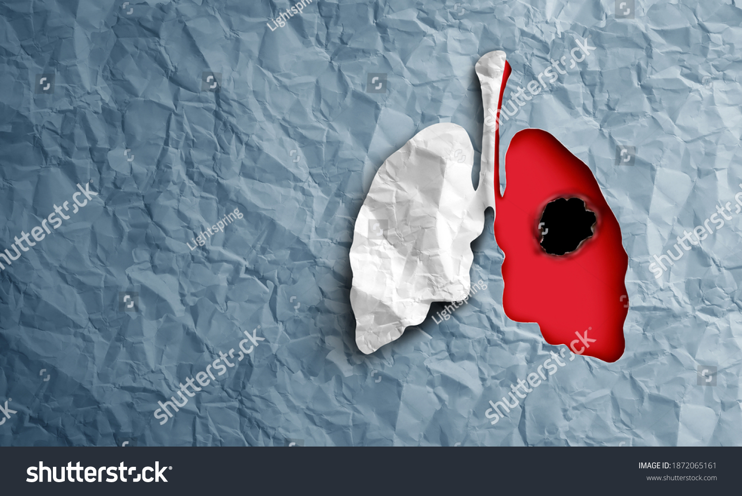 lung-cancer-diagnosis-human-lungs-disease-stock-illustration-1872065161