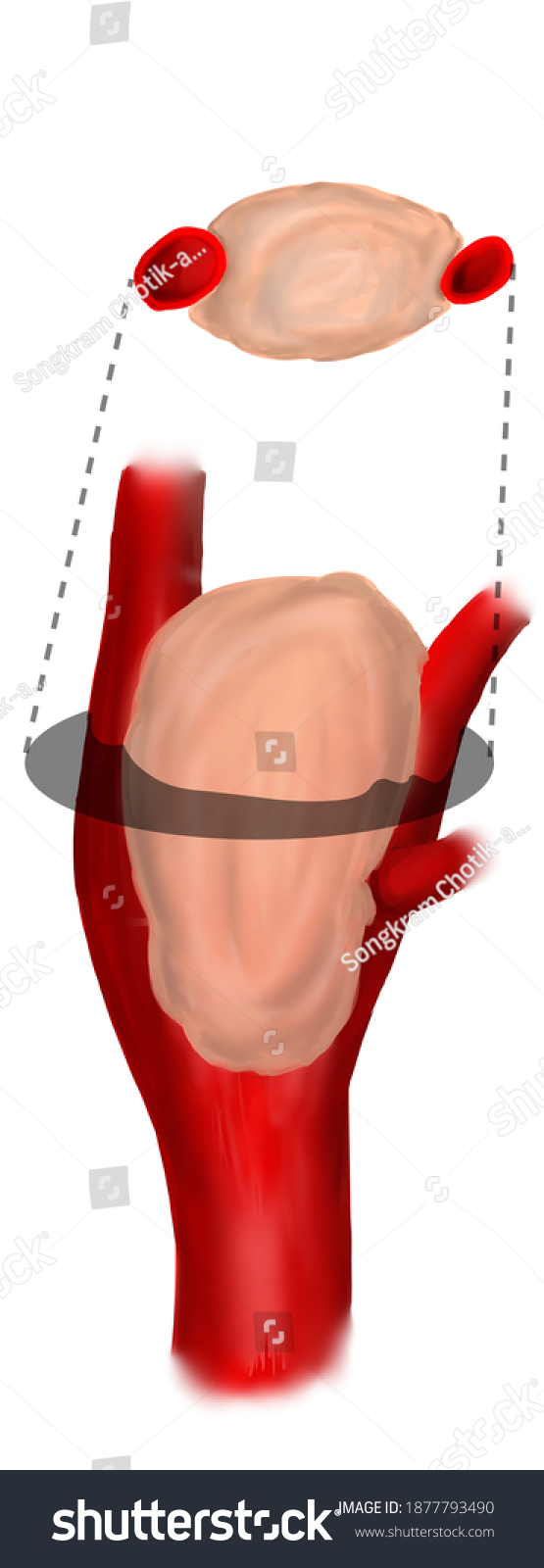 Types Carotid Body Tumor Regarding Classification Stock Illustration