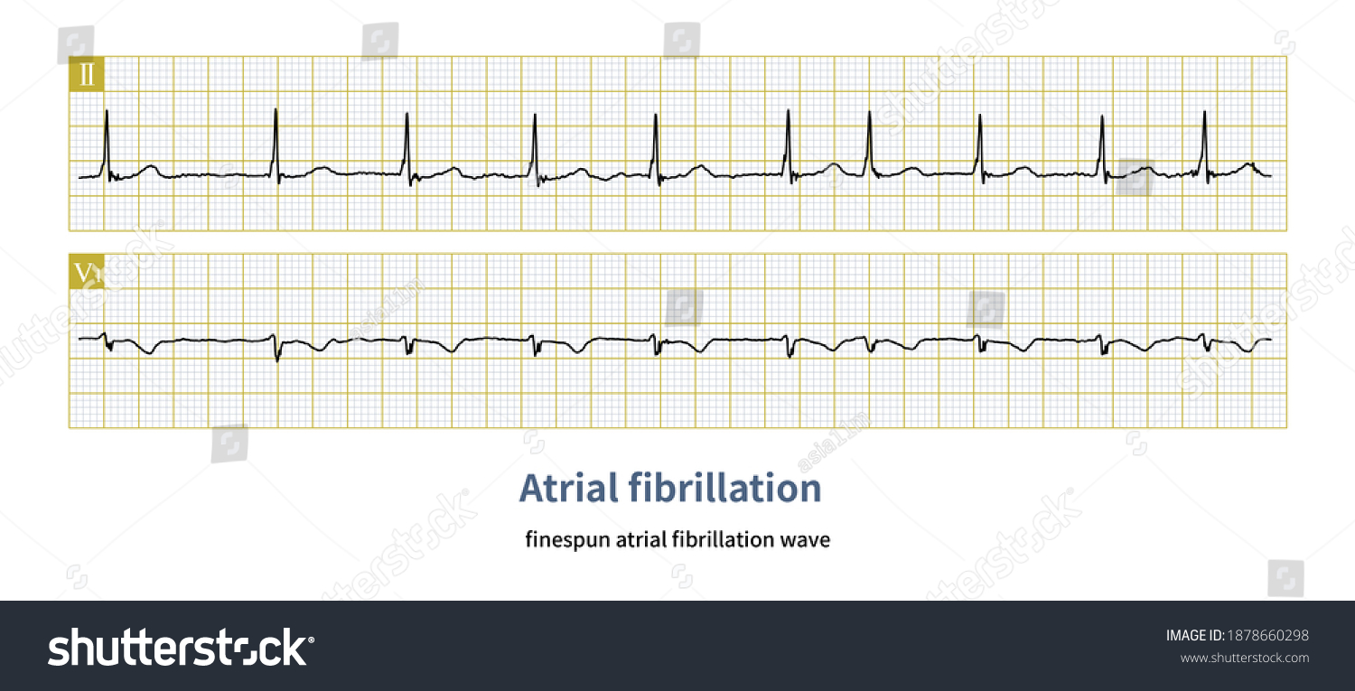 Sometimes Atrial Fibrillation Wave Very Slender Stock Illustration 