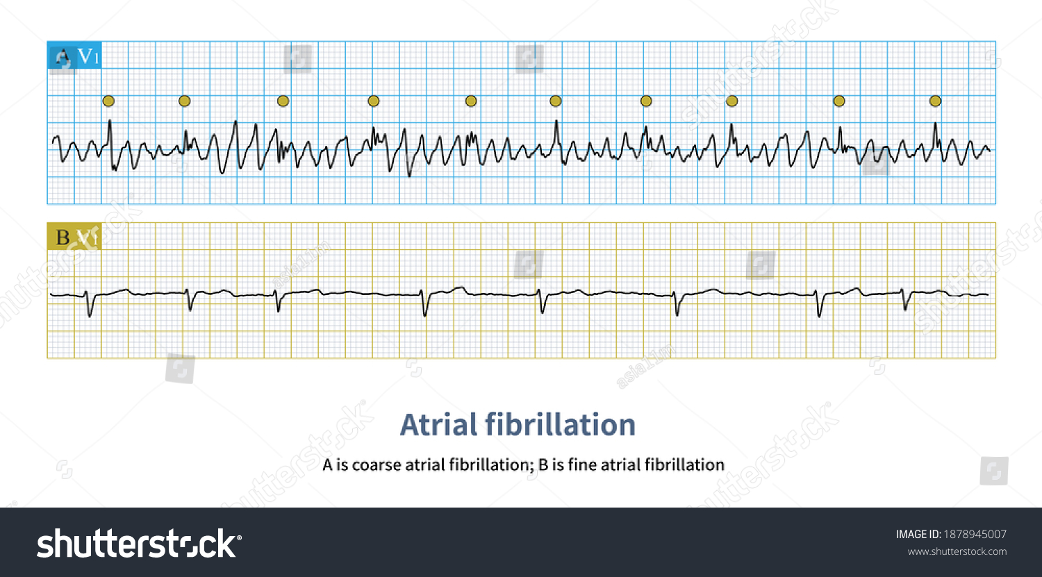 Atrial Fibrillation Waves Divided Into Coarse Stock Illustration ...