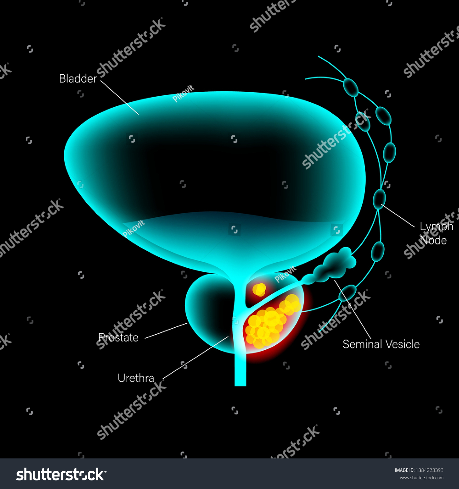 Prostate Cancer Vector Poster Pain Bladder Stock Vector (Royalty Free ...