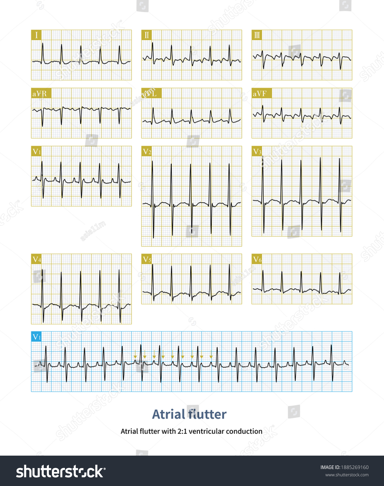 When Atrial Flutter Accompanied By 21 Stock Illustration 1885269160 ...