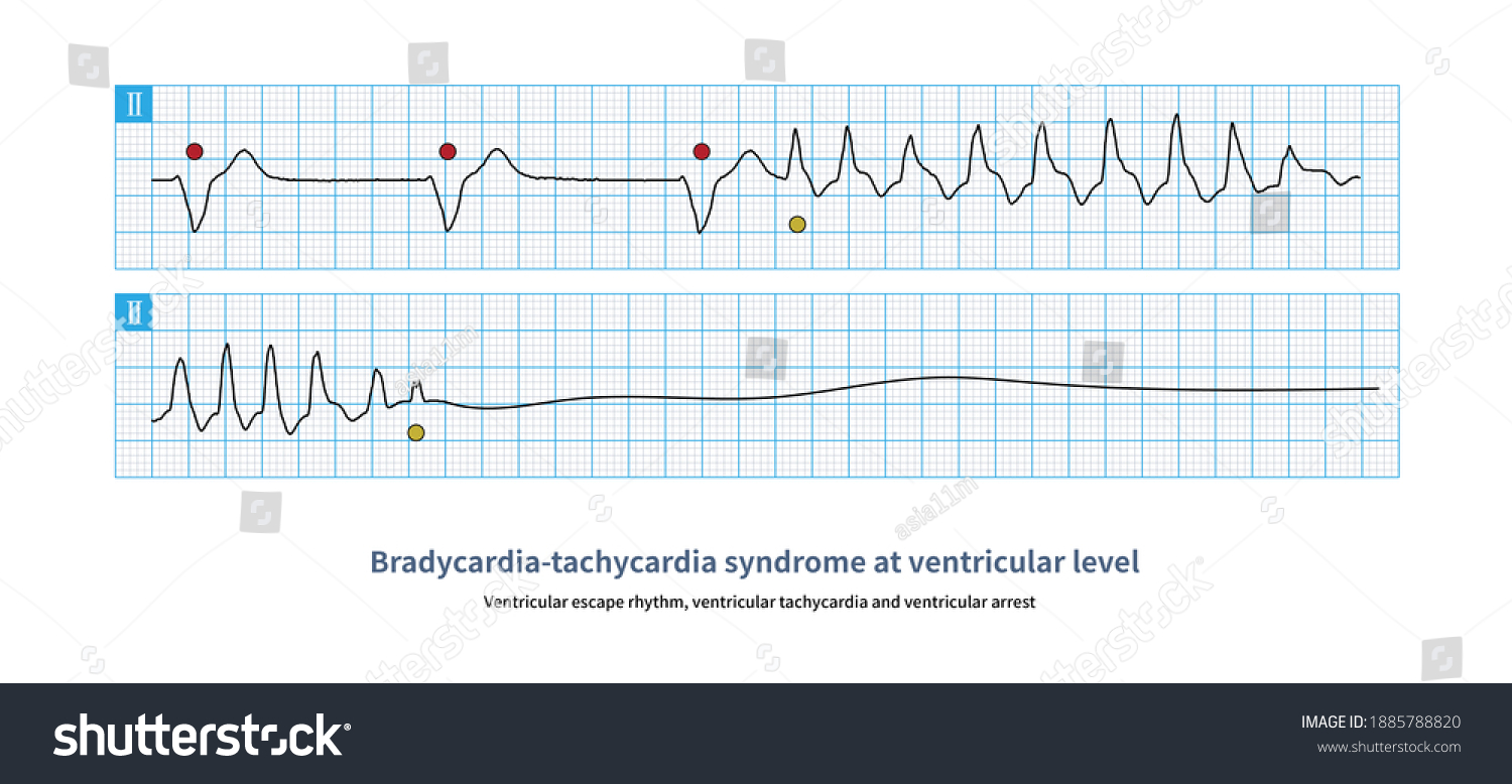 Sometimes Bradycardia Tachycardia Occur Repeatedly Ventricular Stock ...