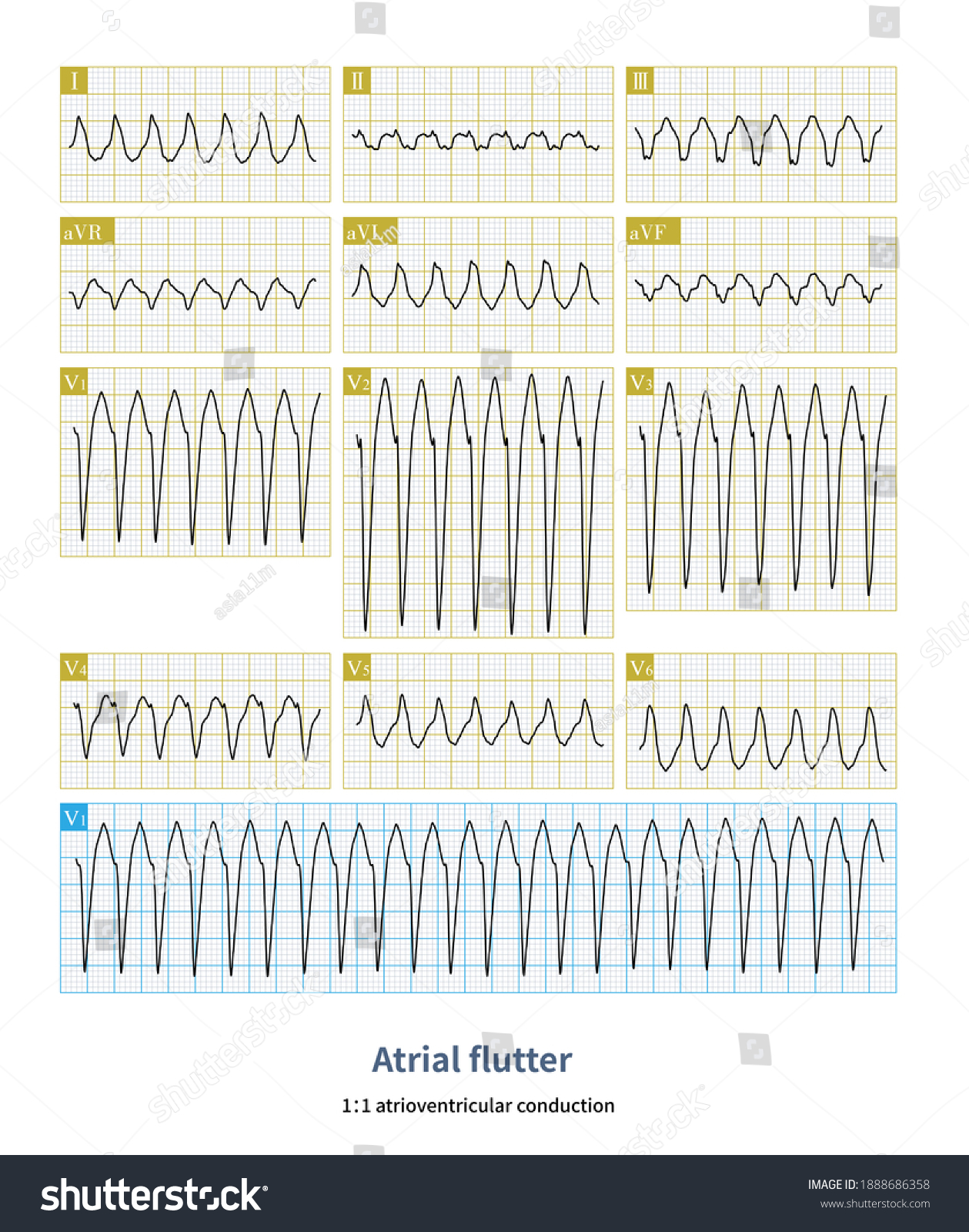 When Atrial Flutter Accompanied By 11 Stock Illustration 1888686358 ...