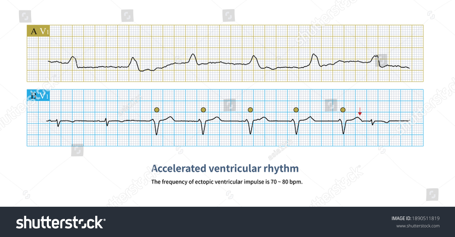 Frequency Ectopic Ventricular Impulse Higher Than Stock Illustration ...