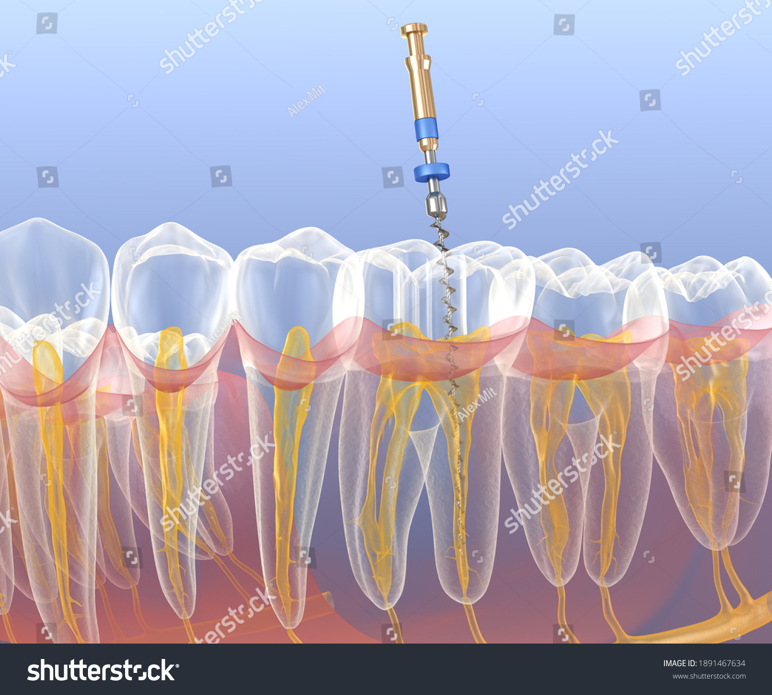 Endodontic Root Canal Treatment Process Medically Stock Illustration 1891467634 Shutterstock 