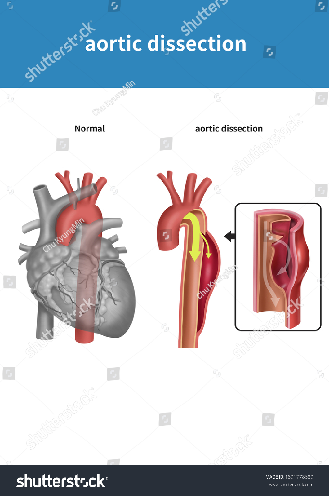 Medical Illustration Explain Aortic Dissection Stock Illustration