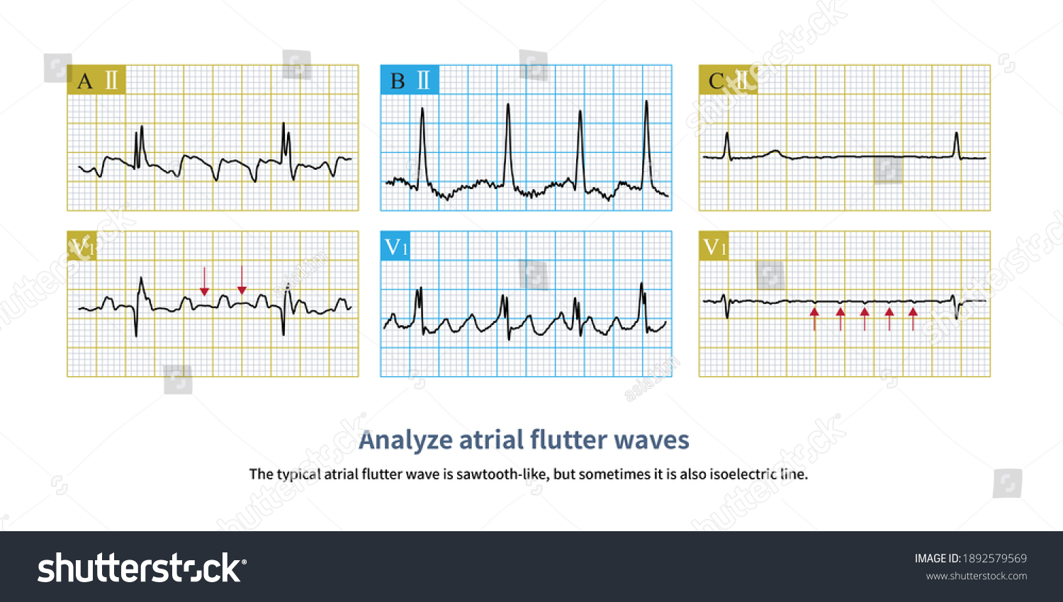 During Atrial Flutter Atrial Flutter Waves Stock Illustration ...