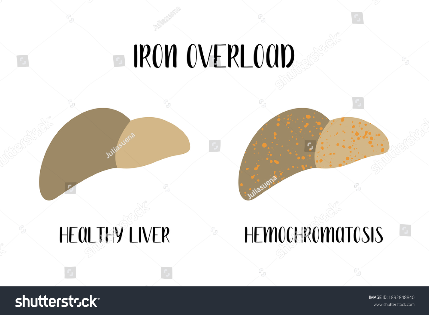 iron-overload-healthy-liver-hemochromatosis-hepatology