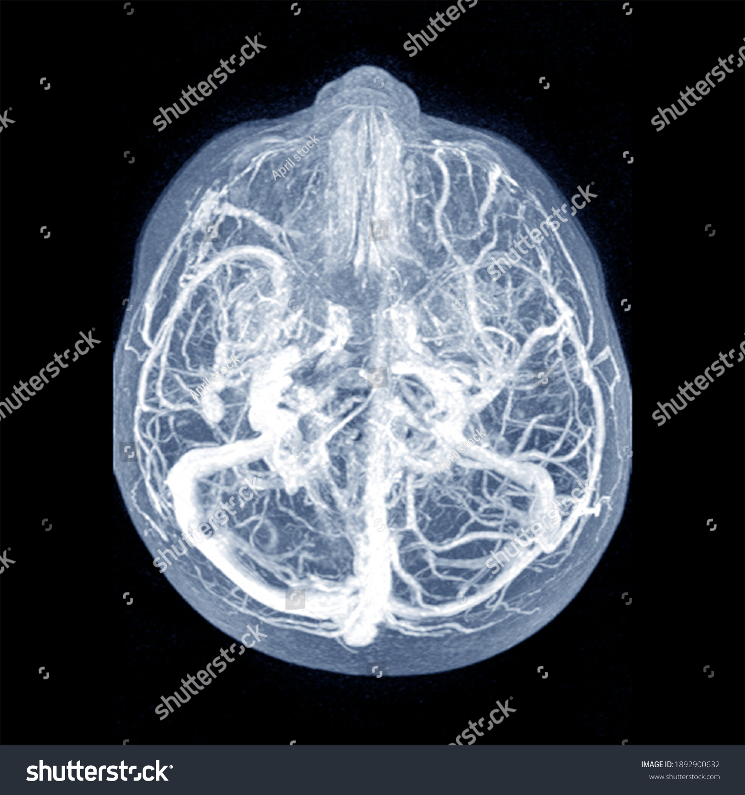 5 Vasogenic brain edema Images, Stock Photos & Vectors | Shutterstock