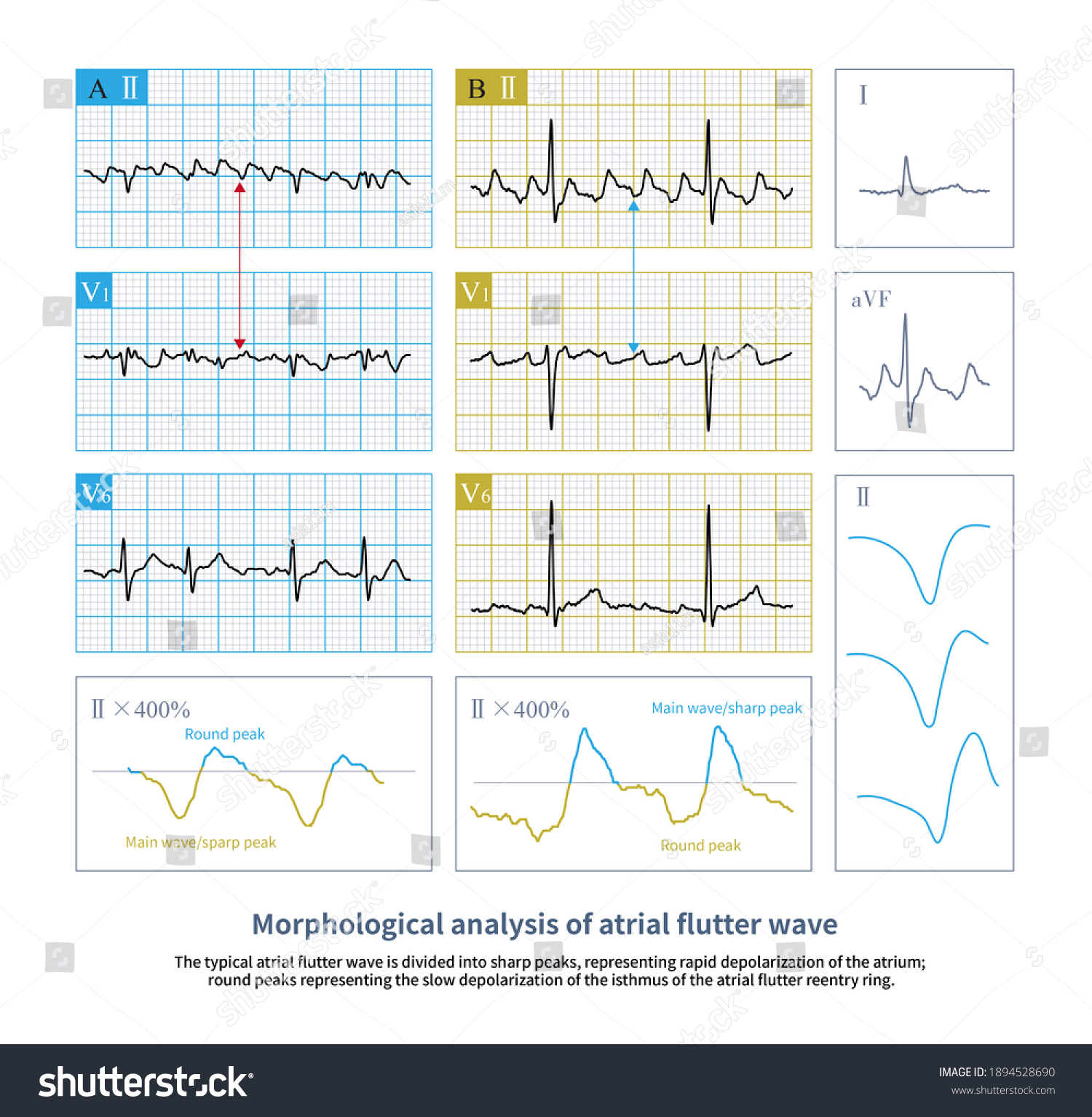 Analyzing Shape Atrial Flutter Wave Can Stock Illustration 1894528690 ...