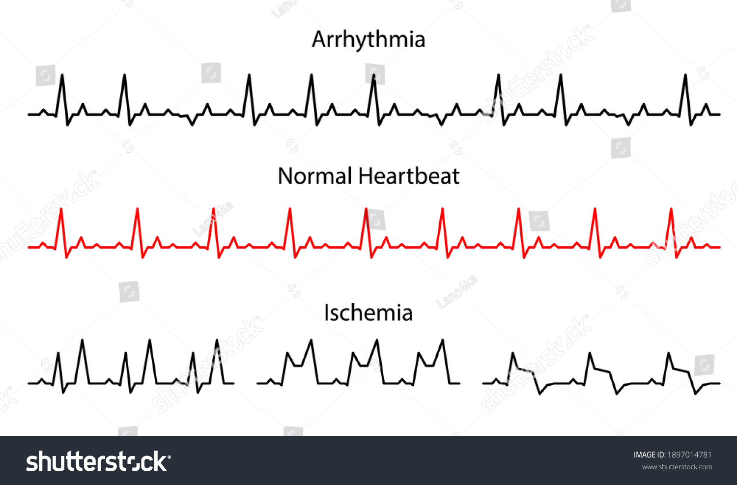 Set Lines Heartbeat Normal Arrhythmia Ischemia Stock Vector (Royalty ...