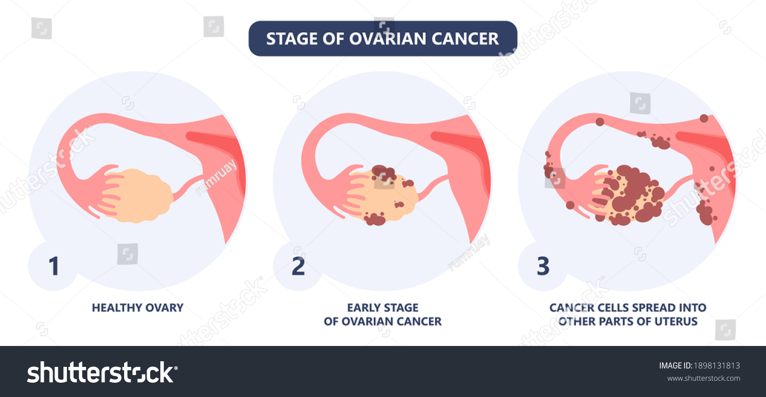 Cancer Pelvic Pcos Ovary Endo Belly Stock Vector Royalty Free 1898131813 Shutterstock 