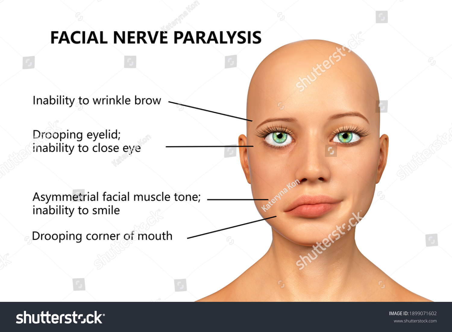 Facial Nerve Paralysis Bells Palsy 3d Stock Illustration 1899071602 ...