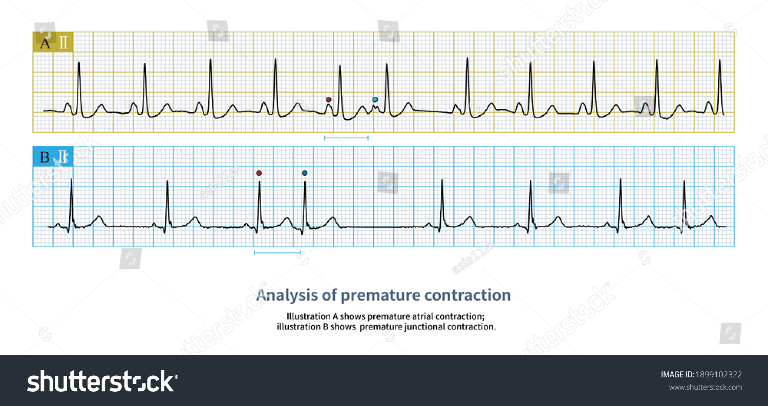 There Ectopic Atrial P Wave Premature Stock Illustration 1899102322 ...