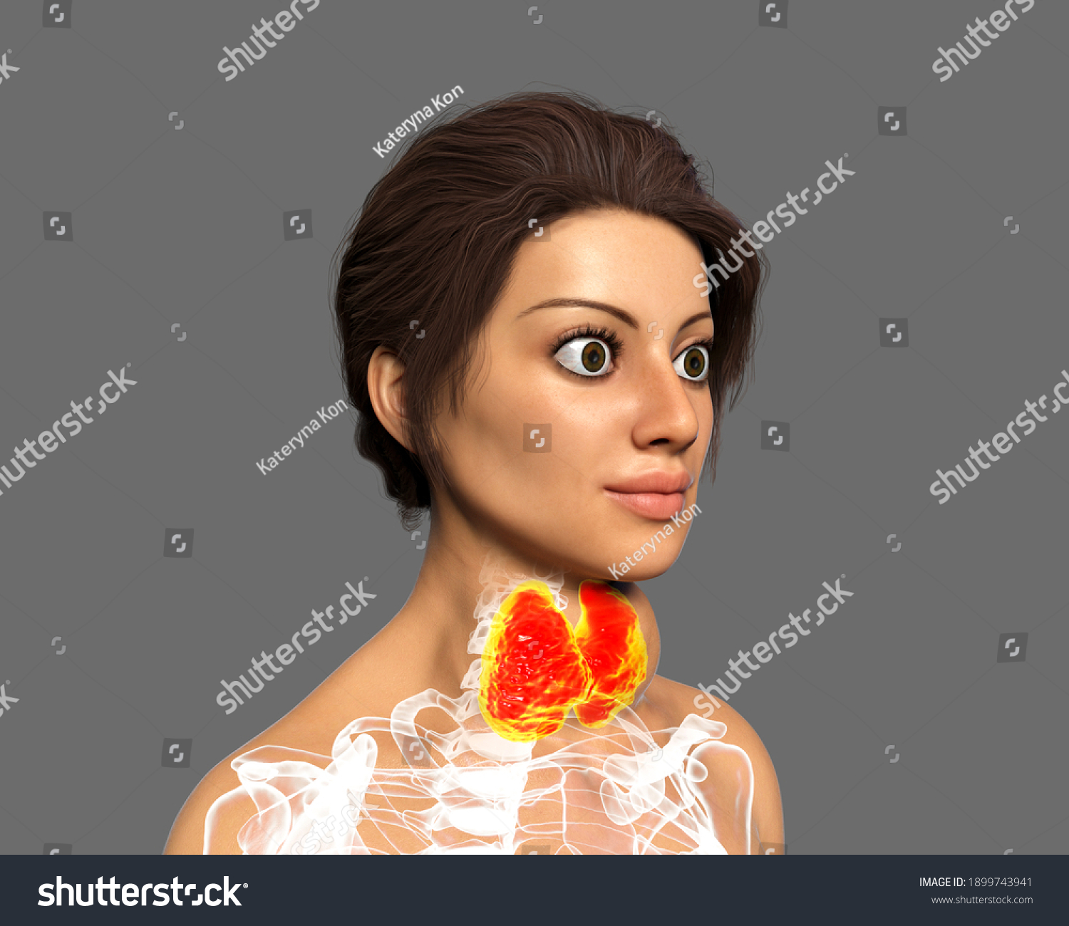 Hyperthyroidism 3d Illustration Showing Enlarged Thyroid Stock