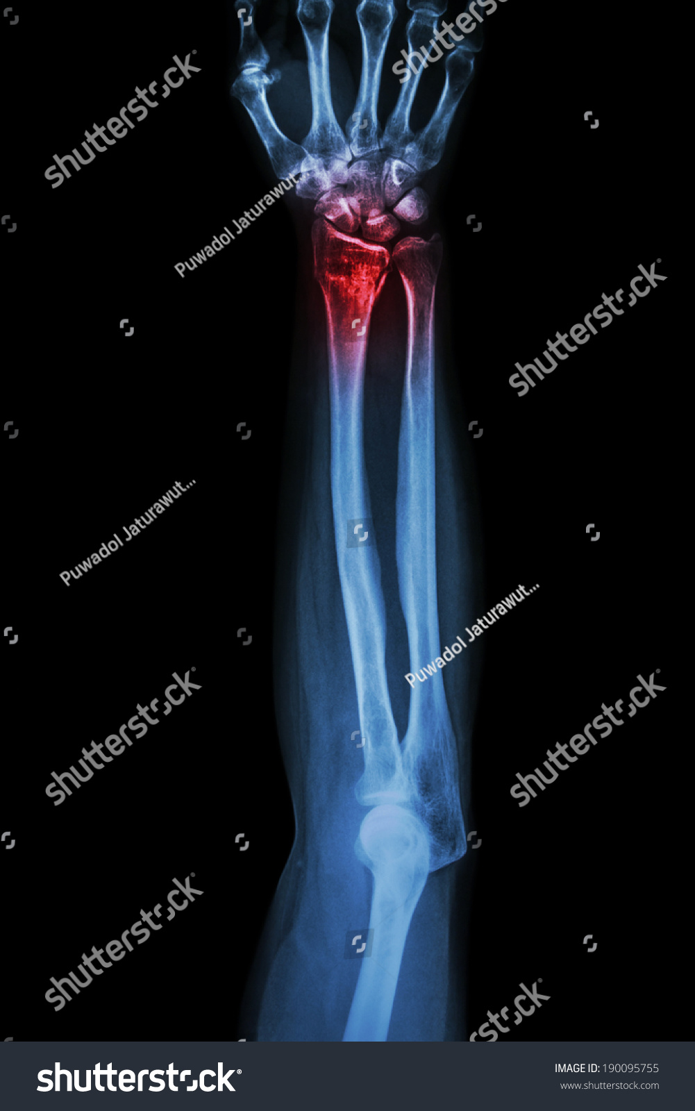 Fracture Distal Radius Wrist Bone Colles Stock Photo 190095755 ...