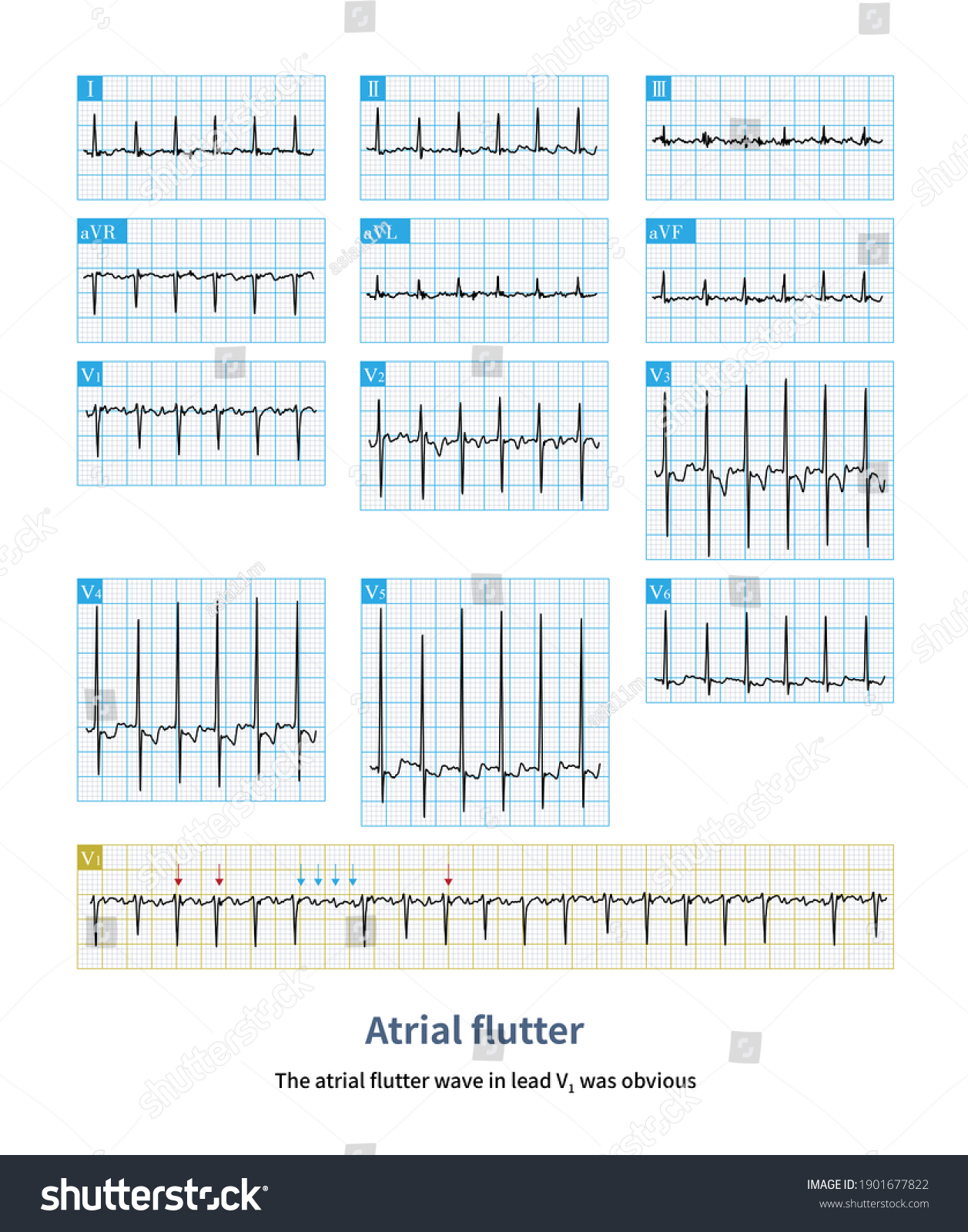 When Atrial Flutter Accompanied By 11 Stock Illustration 1901677822 