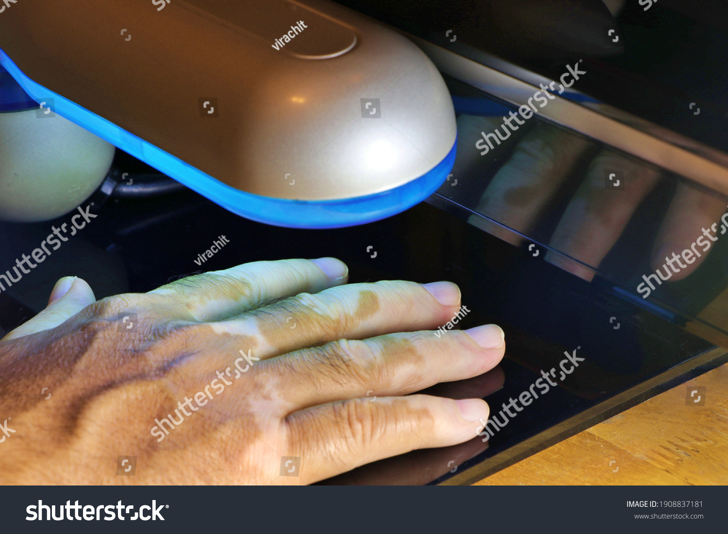 639 Vitiligo And Psoriasis Images, Stock Photos & Vectors | Shutterstock