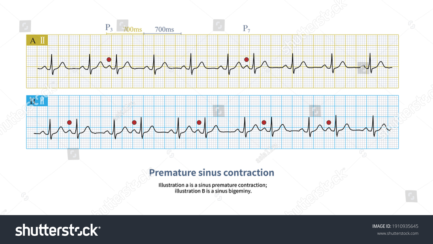 Sinus Premature Beat Rare Arrhythmia Which Stock Illustration ...