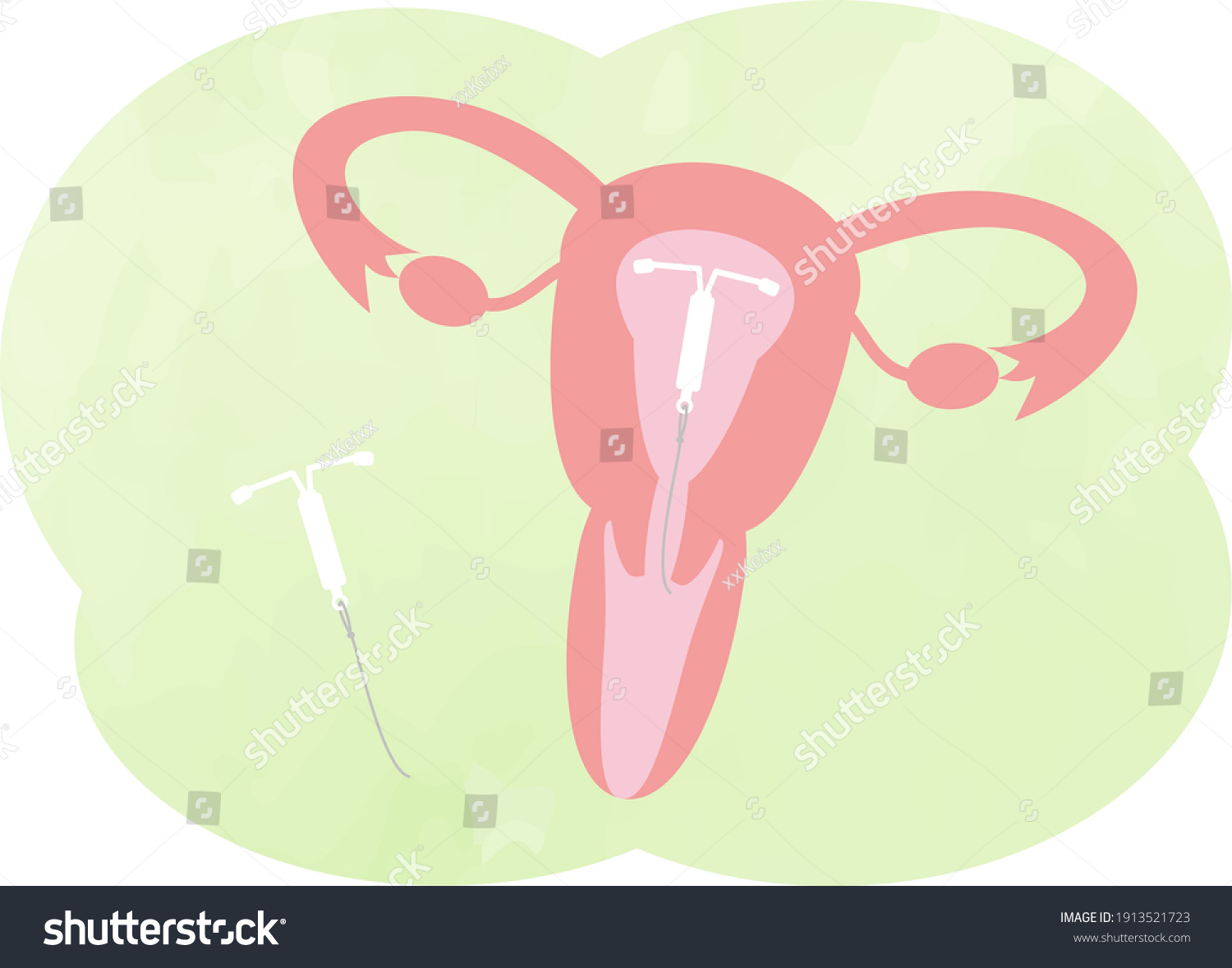 This Illustration Iud Intrauterine Device Stock Vector Royalty Free   Stock Vector This Is An Illustration Of An Iud Intrauterine Device 1913521723 