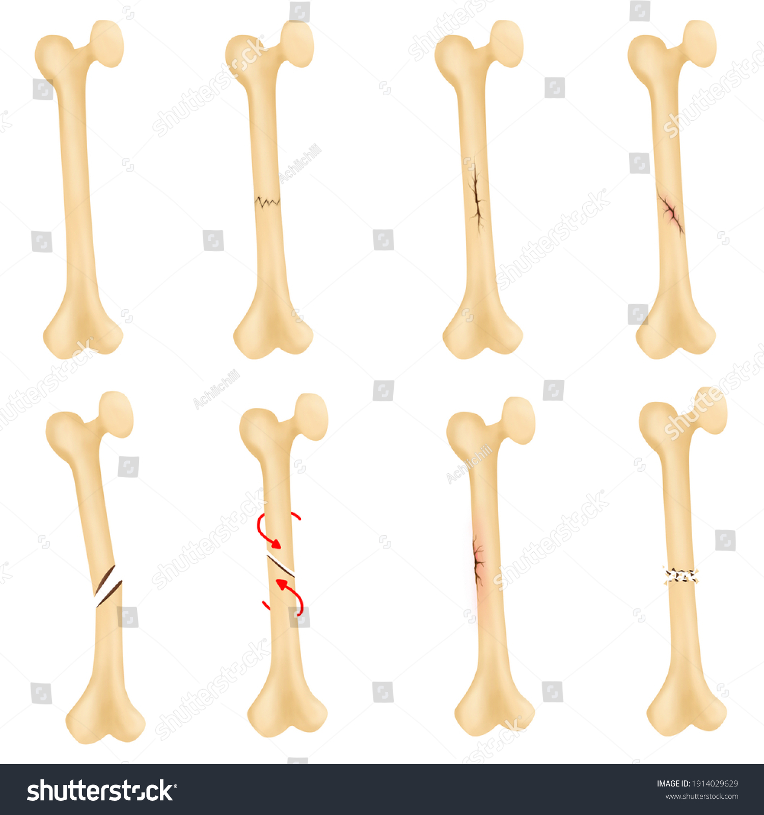 Broken Bone Fracture Stock Illustration 1914029629 | Shutterstock