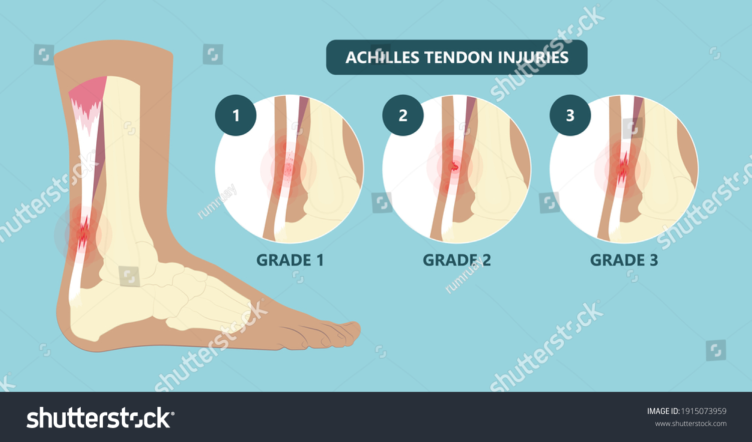 Achilles Tendon Rupture Injury Feet Calf Stock Vector (Royalty Free ...