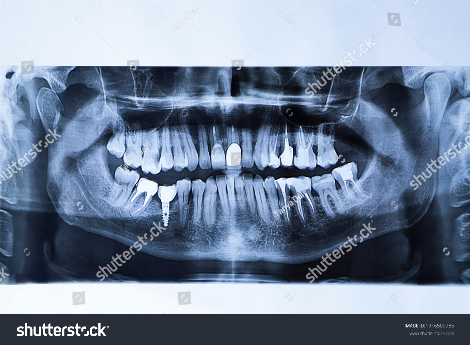 3,052 X Ray Screw Images, Stock Photos & Vectors 