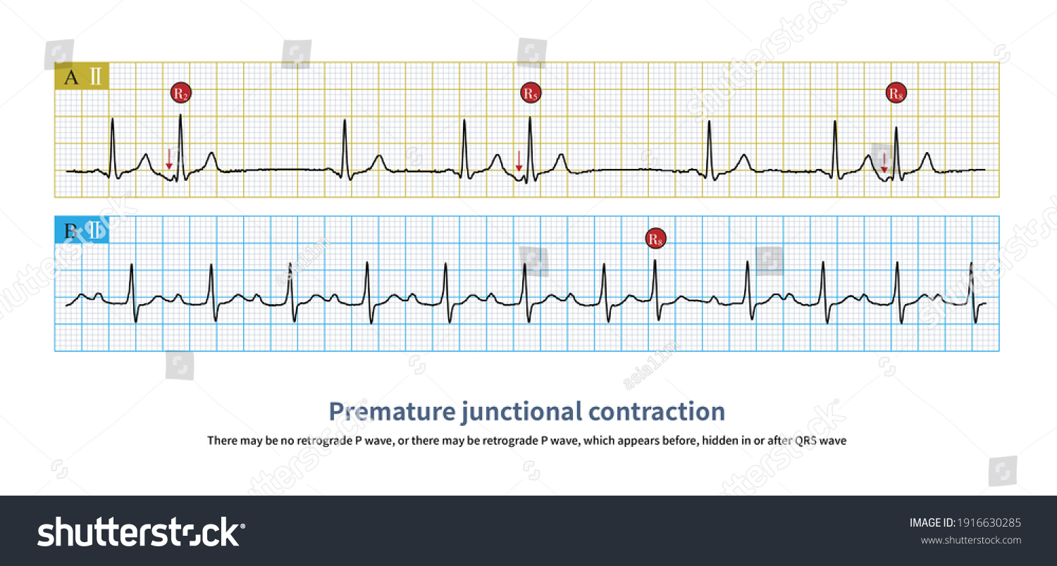 13 Ekg premature junctional Images, Stock Photos & Vectors | Shutterstock