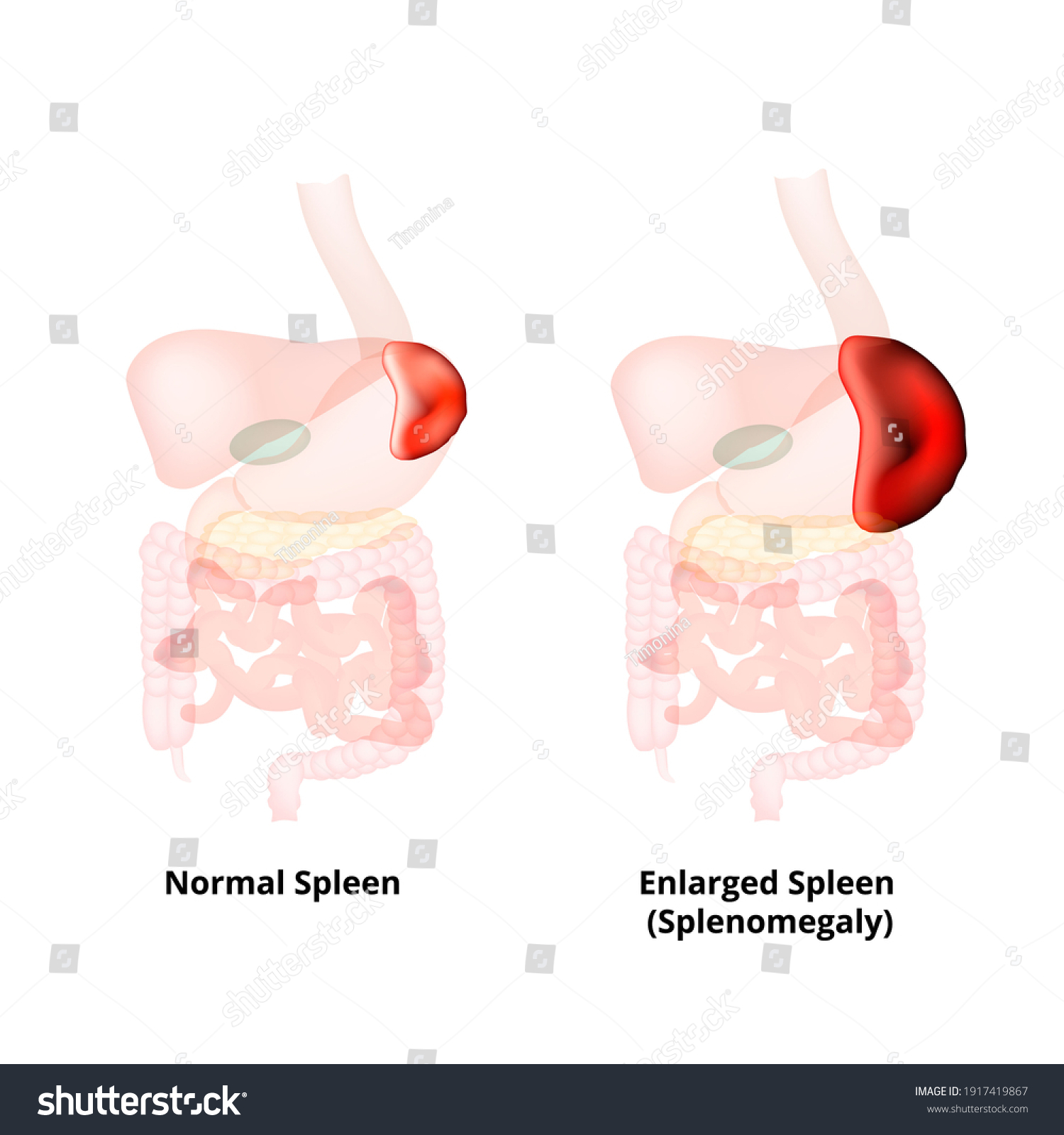 normal and enlarged spleen
