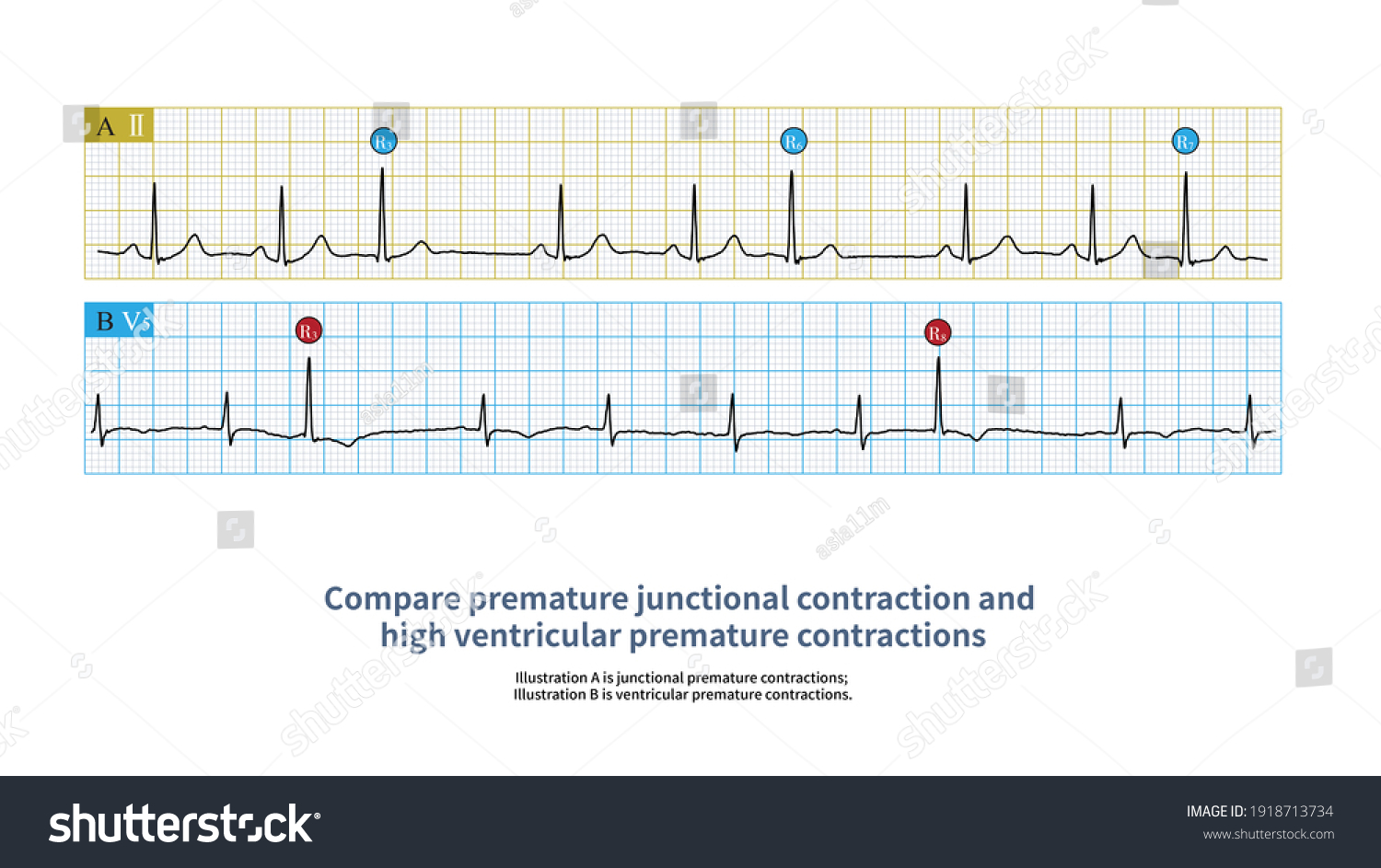 When Ventricular Premature Contractions Originate Ventricular Stock ...