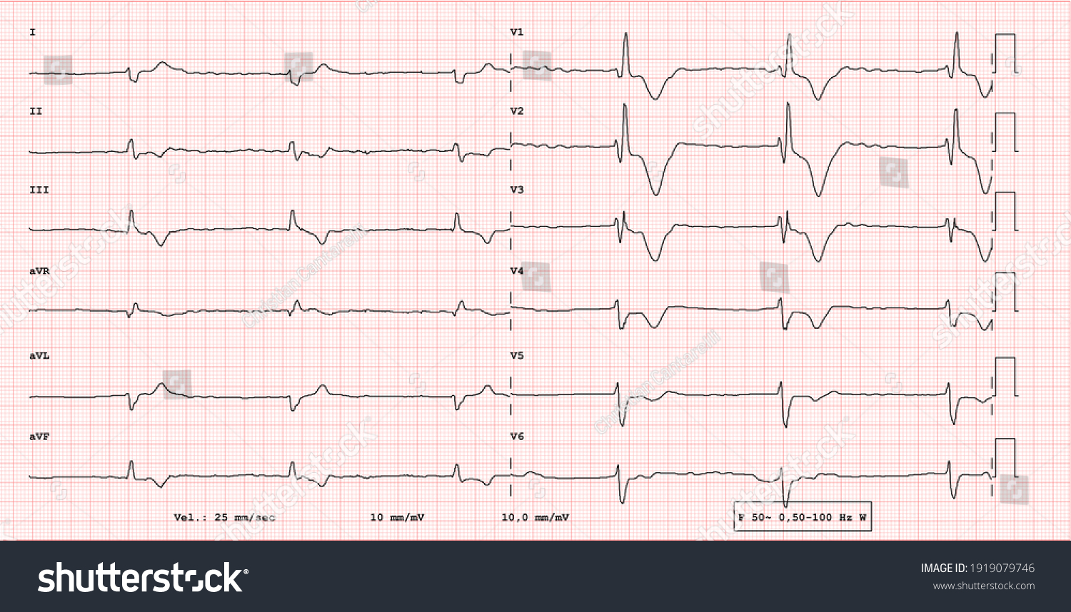 Ecg Example Pathological 12lead Rhythm Atrial Stock Illustration ...