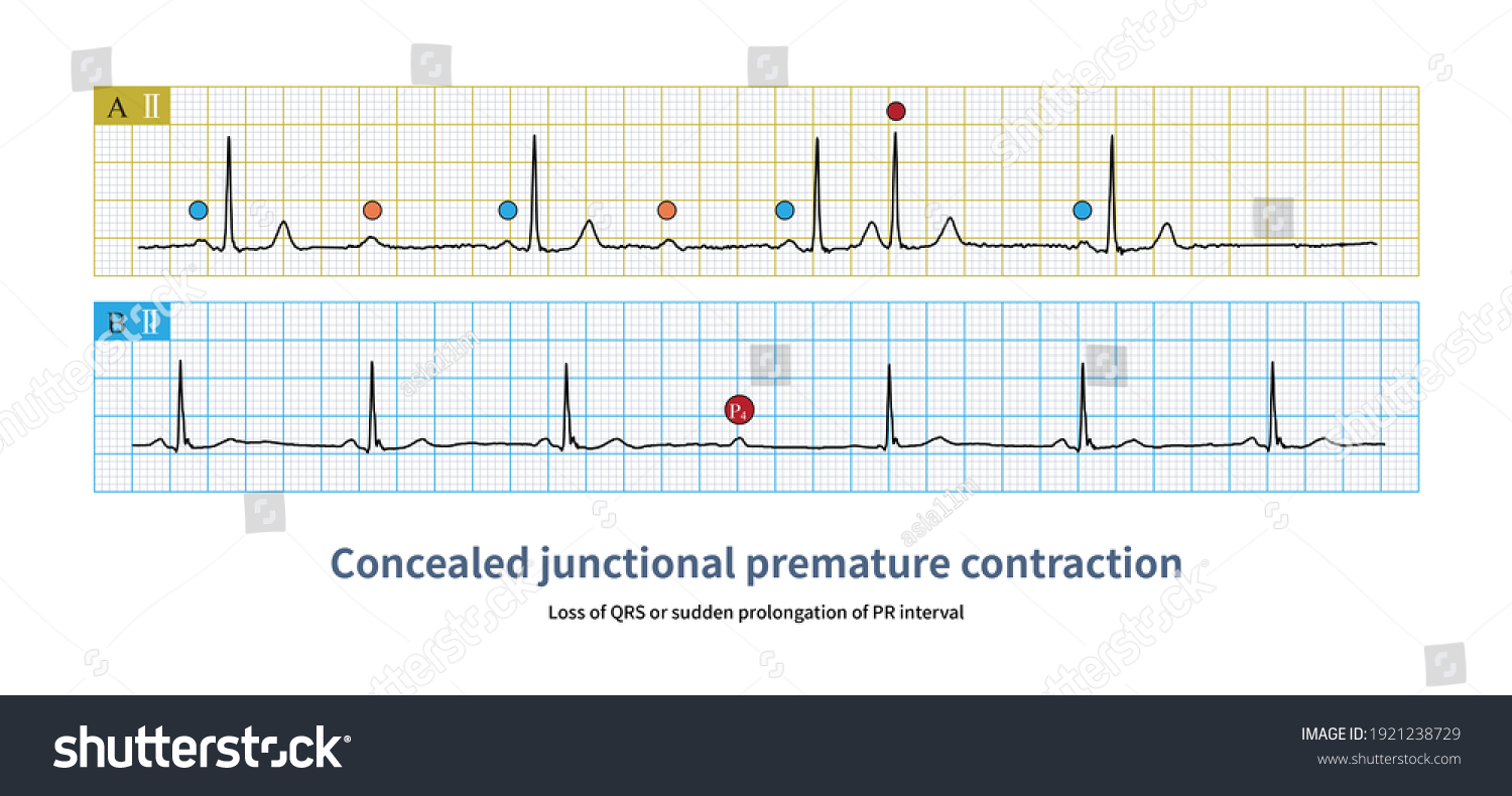 Sometimes Junctional Premature Contractions Concealed On Stock ...