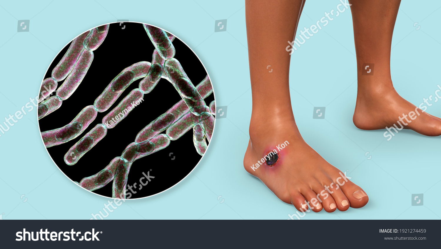 Cutaneous Anthrax Most Common Form Anthrax Stock Illustration 1921274459 Shutterstock 4179