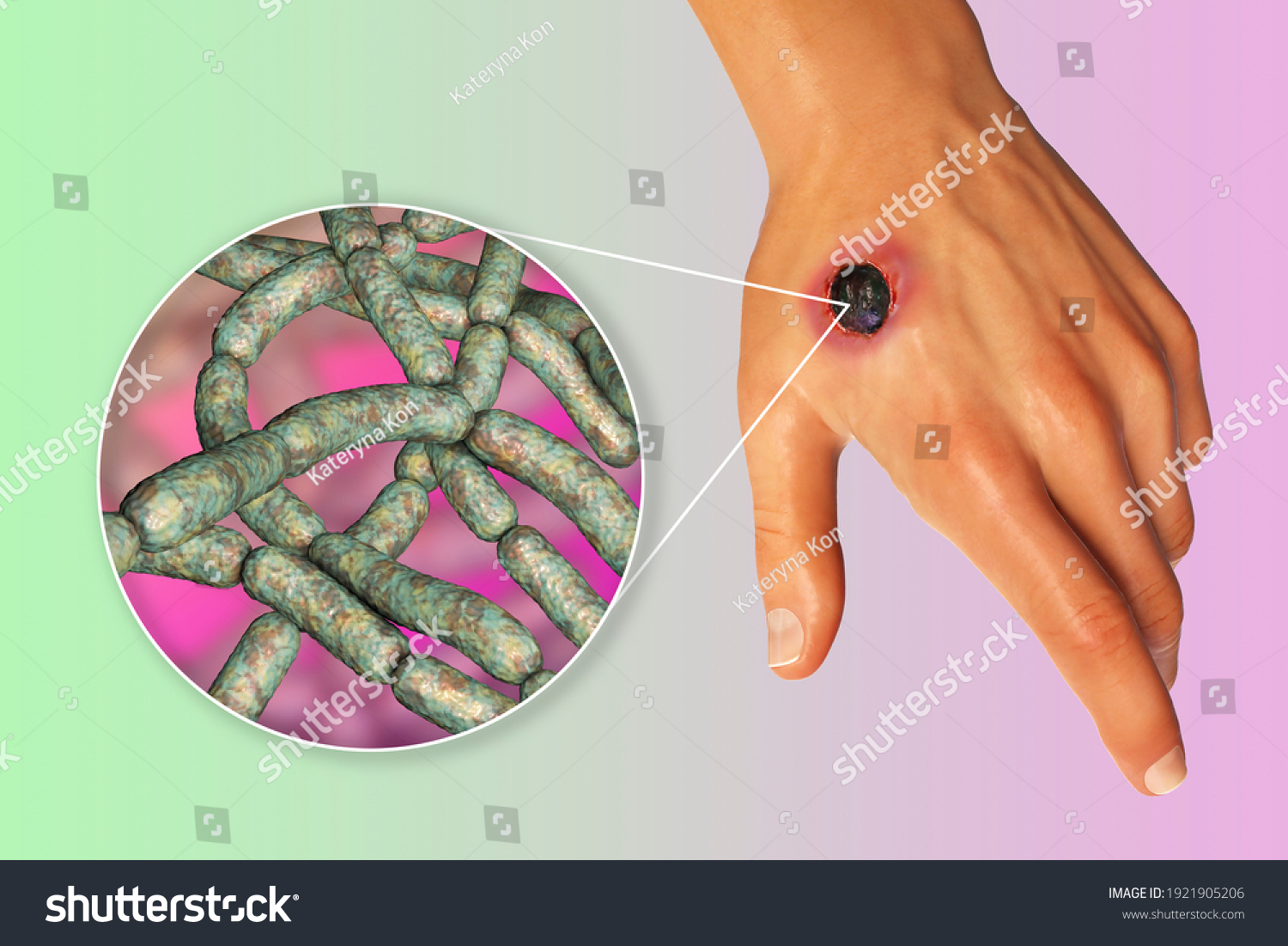 Cutaneous Anthrax Most Common Form Anthrax Stock Illustration 1921905206 Shutterstock 8223
