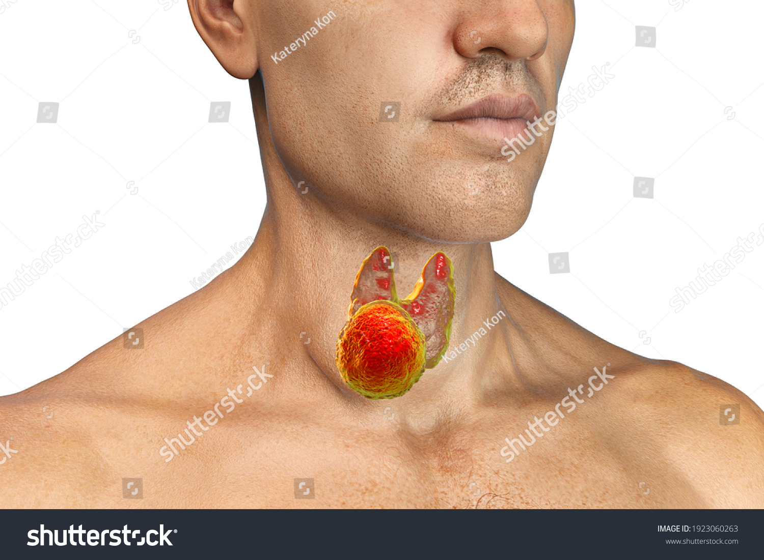 Thyroid Cancer Men 3d Illustration Showing Stock Illustration ...