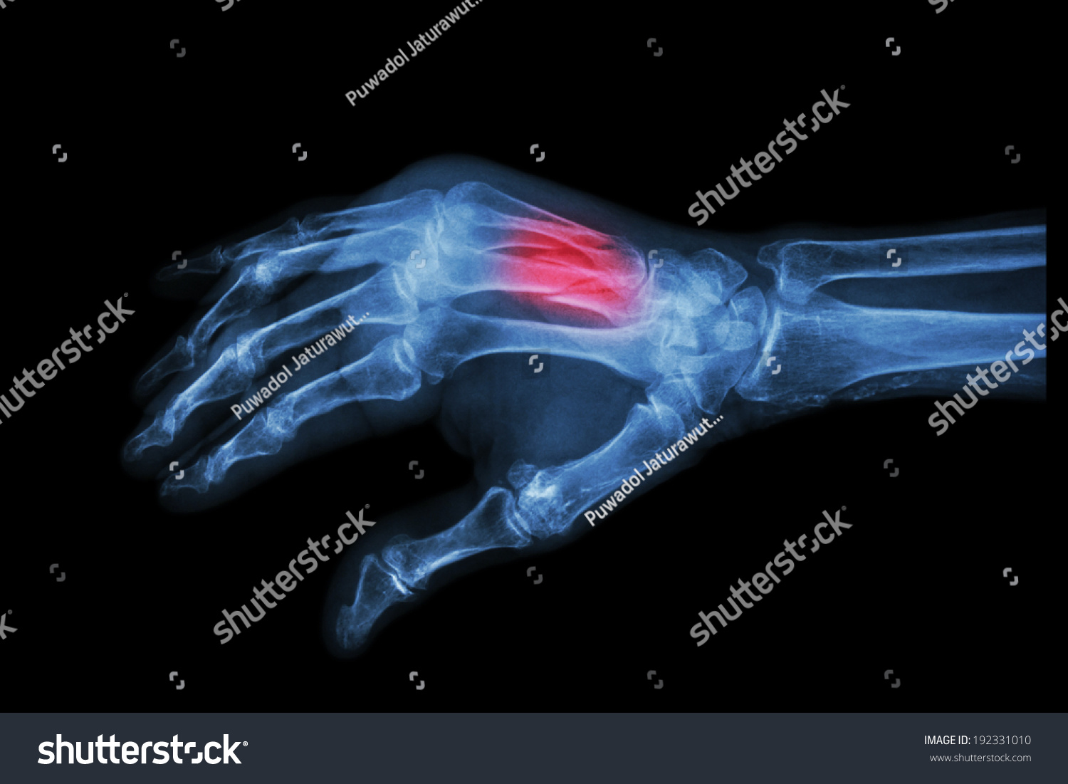 Film Xray Hand Oblique Fracture 3rd Stock Photo 192331010 | Shutterstock