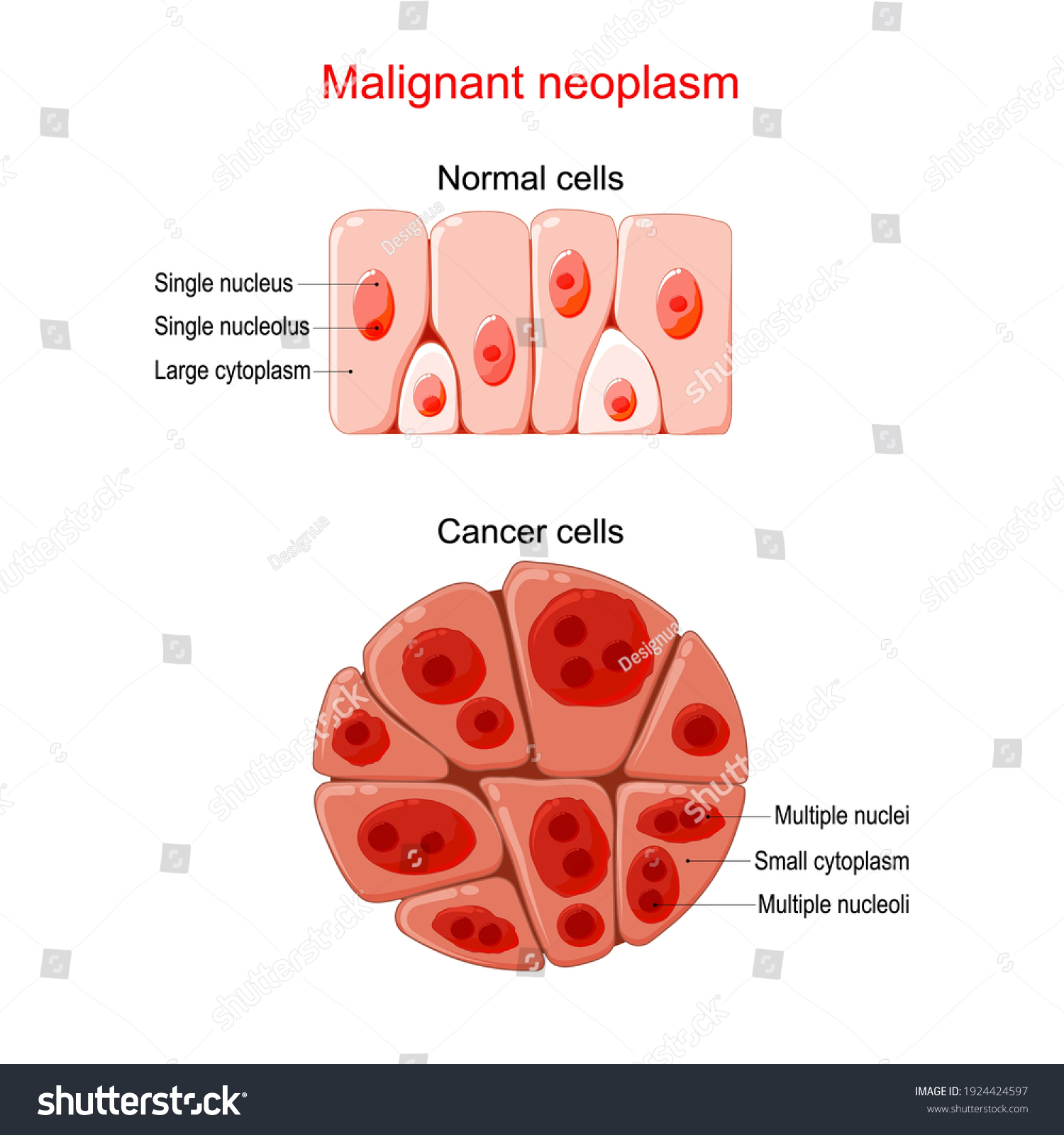 Malignant Neoplasm Cancer Normal Cells Comparison Stock Vector (Royalty ...