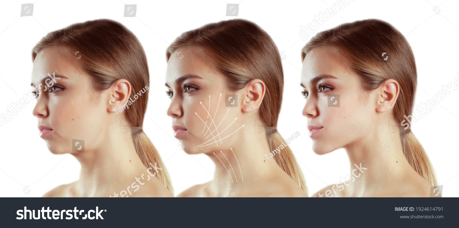 Woman Double Chin Before After Stock Photo Shutterstock