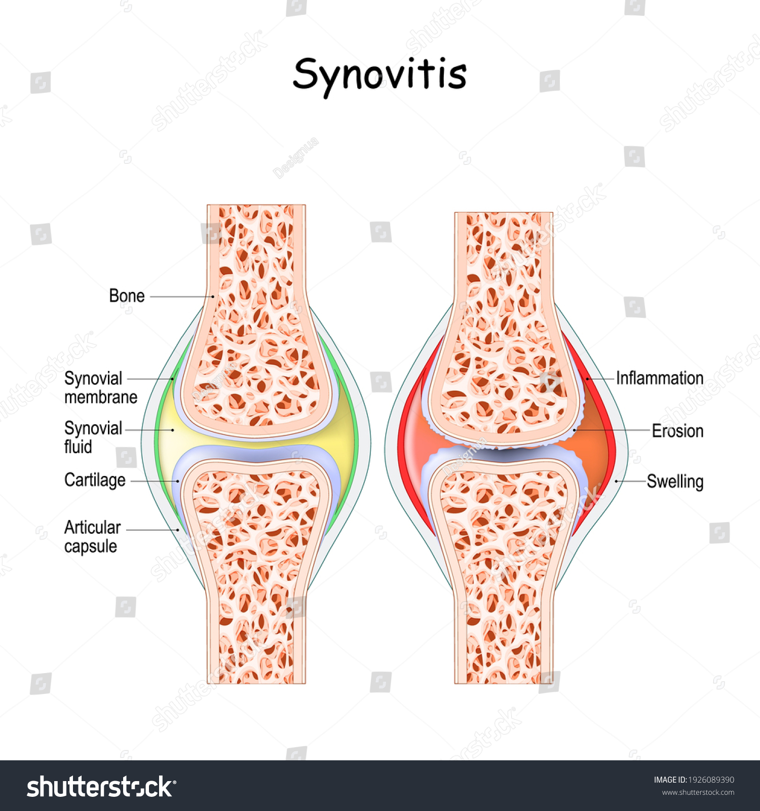 Синовит это. Синовит классификация. Synovial Италия. Синовит сироп.