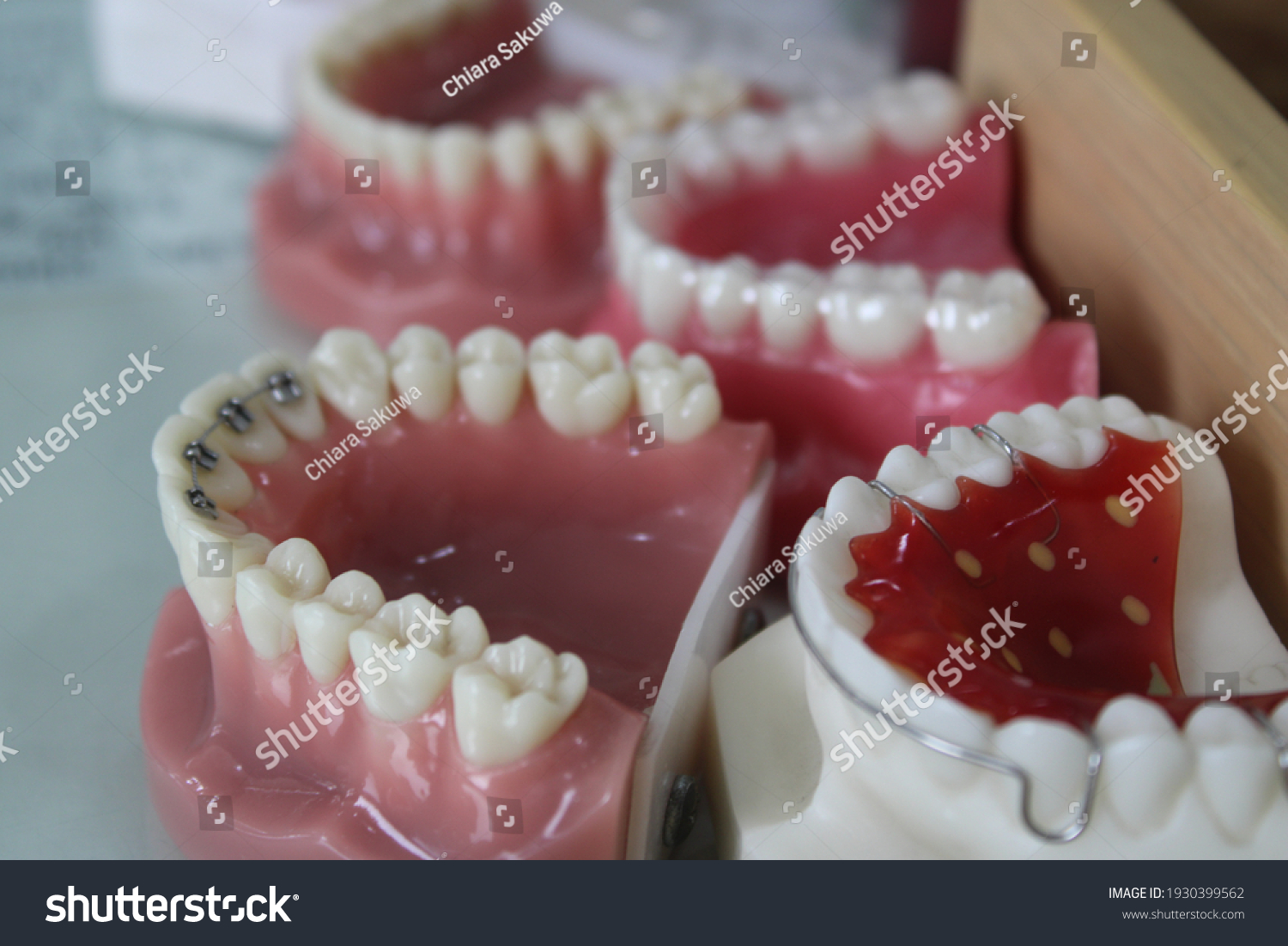 Dental Models Showing Different Types Orthodontic Stock Photo ...