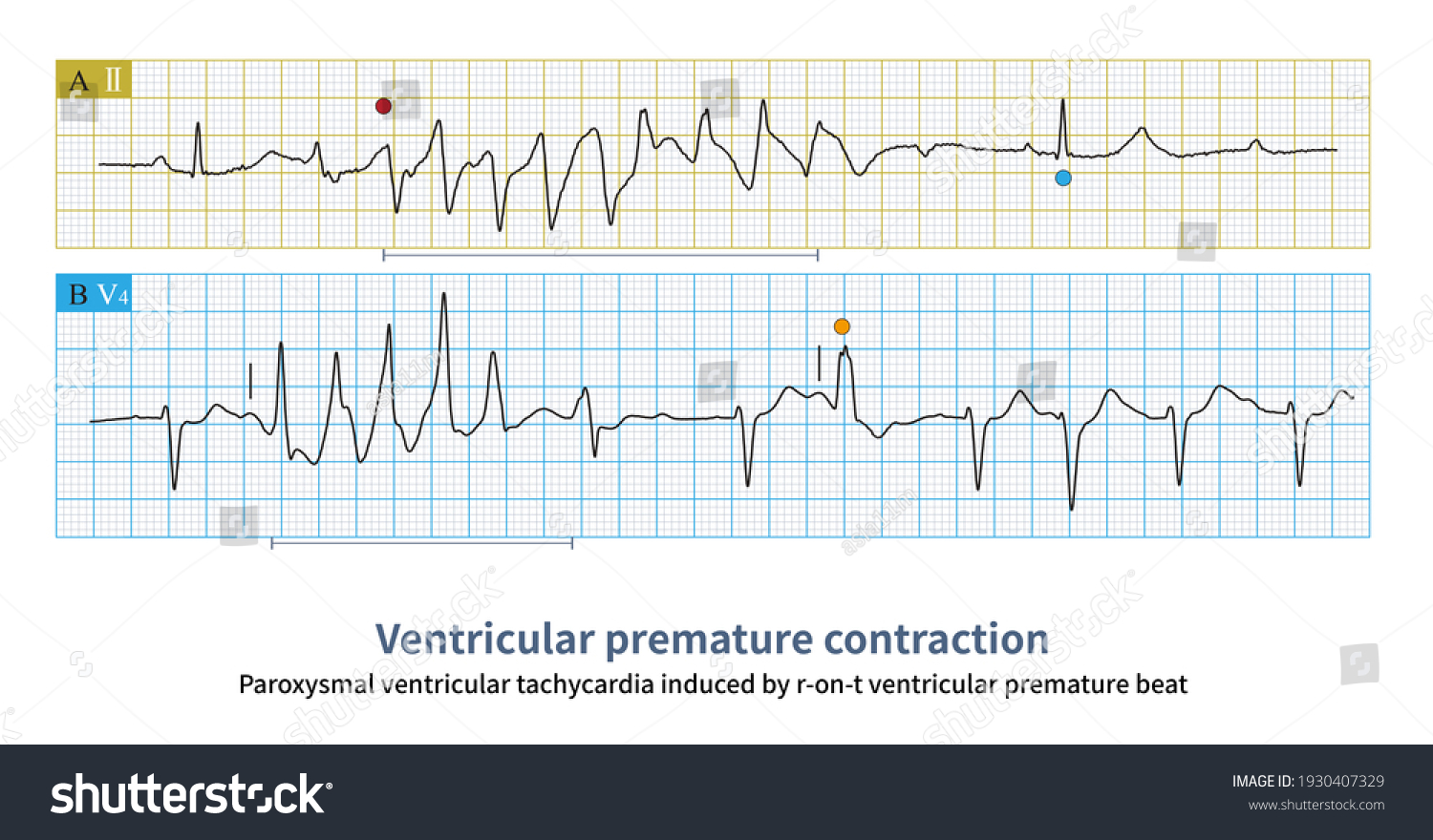 Paroxysmal Ventricular Tachycardia Pvt Induced By Stock Illustration ...